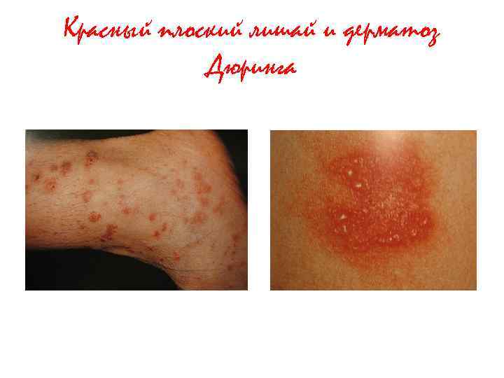 Красный плоский лишай и дерматоз Дюринга 