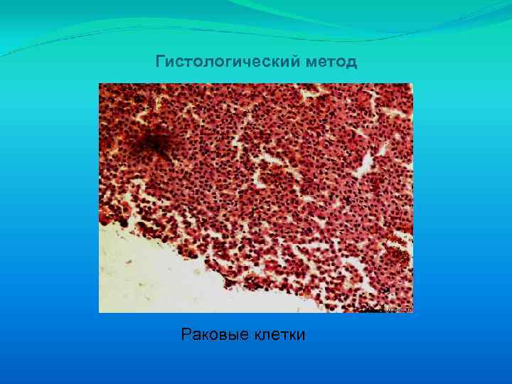 Гистологический метод Раковые клетки 