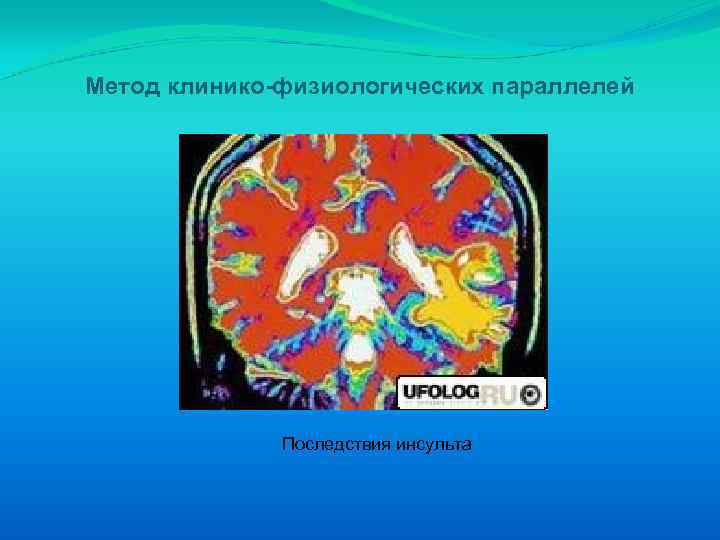 Метод клинико-физиологических параллелей Последствия инсульта 