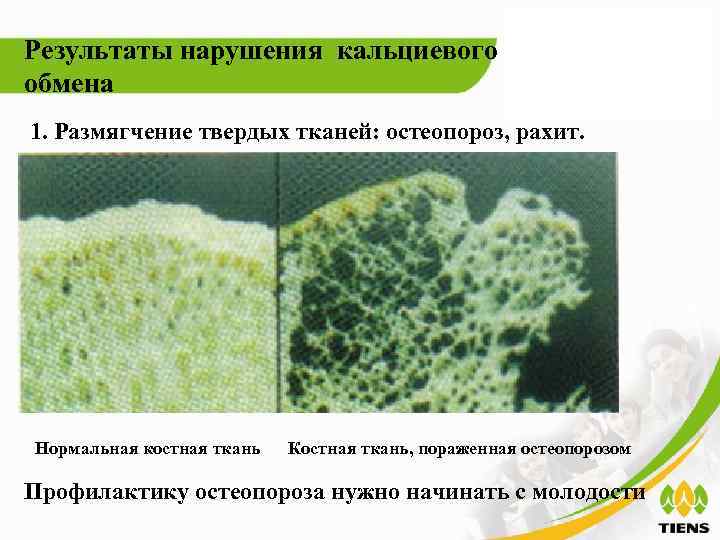 Результаты нарушения кальциевого обмена 1. Размягчение твердых тканей: остеопороз, рахит. Нормальная костная ткань Костная