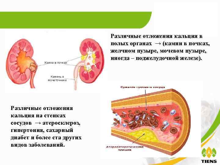 Различные отложения кальция в полых органах → (камни в почках, желчном пузыре, мочевом пузыре,