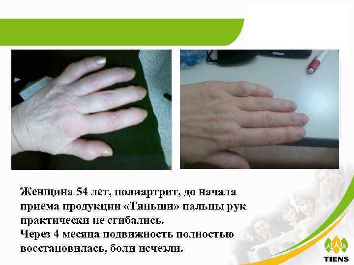 Женщина 54 лет, полиартрит, до начала приема продукции «Тяньши» пальцы рук практически не сгибались.