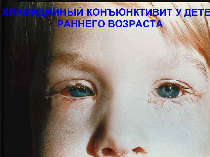 ХЛАМИДИЙНЫЙ КОНЪЮНКТИВИТ У ДЕТЕ РАННЕГО ВОЗРАСТА 