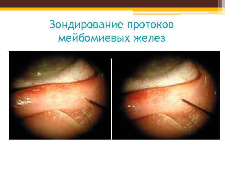 Зондирование протоков мейбомиевых желез 