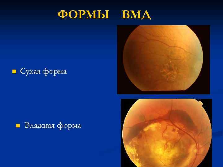 ФОРМЫ ВМД n Сухая форма n Влажная форма 