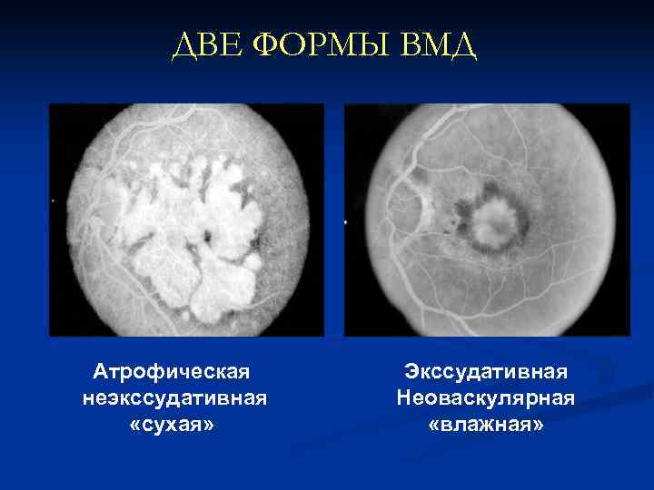 ДВЕ ФОРМЫ ВМД Атрофическая неэкссудативная «сухая» Экссудативная Неоваскулярная «влажная» 