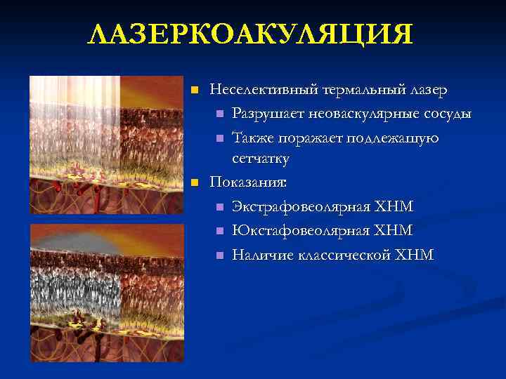 ЛАЗЕРКОАКУЛЯЦИЯ n n Неселективный термальный лазер n Разрушает неоваскулярные сосуды n Также поражает подлежащую