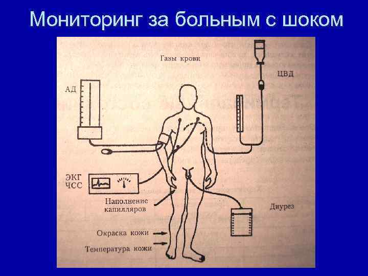 Мониторинг за больным с шоком 