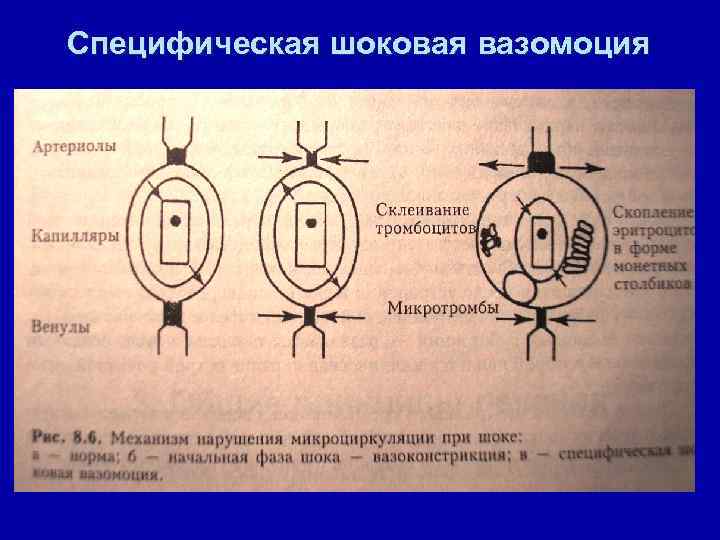 Специфическая шоковая вазомоция 