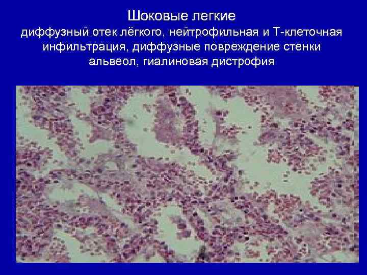 Шоковые легкие диффузный отек лёгкого, нейтрофильная и Т-клеточная инфильтрация, диффузные повреждение стенки альвеол, гиалиновая