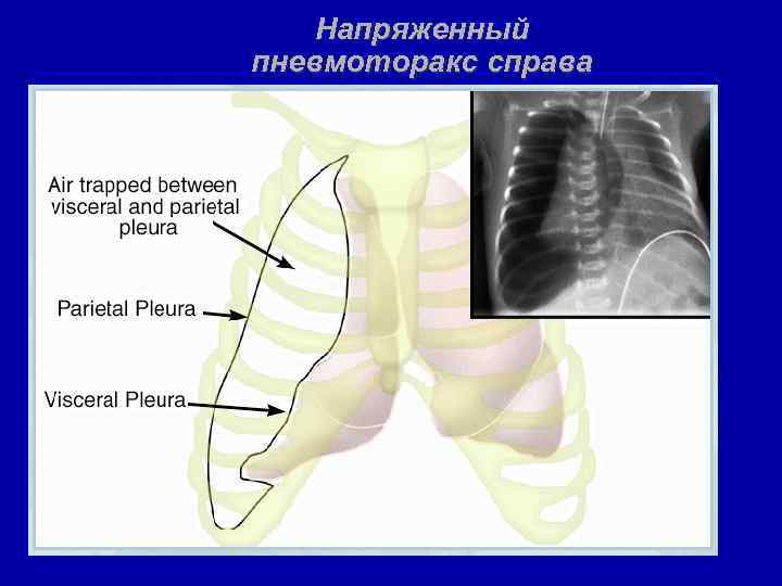 Напряженный пневмоторакс справа 