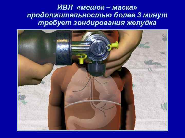 ИВЛ «мешок – маска» продолжительностью более 3 минут требует зондирования желудка 