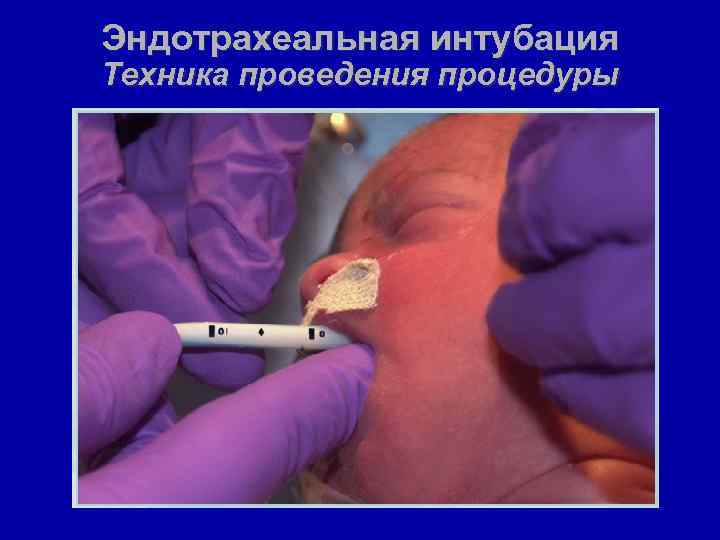 Эндотрахеальная интубация Техника проведения процедуры 