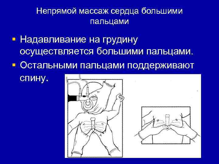 Непрямой массаж сердца большими пальцами § Надавливание на грудину осуществляется большими пальцами. § Остальными