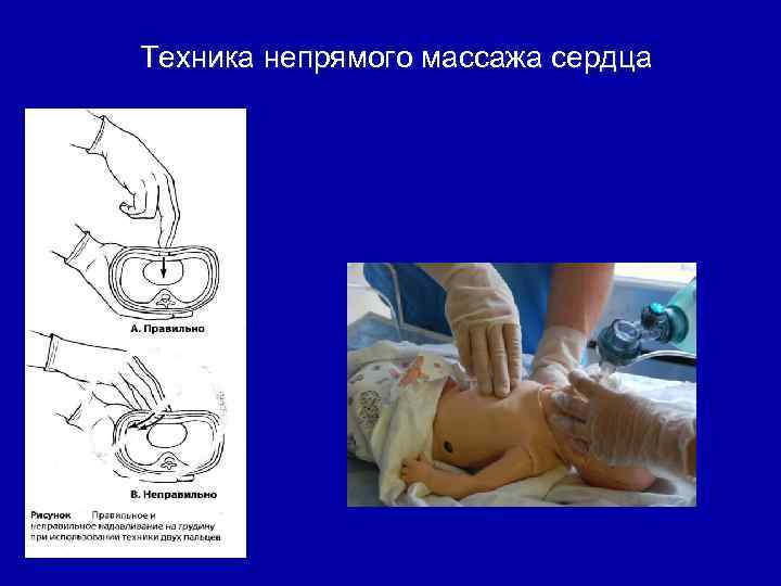 Техника непрямого массажа сердца 