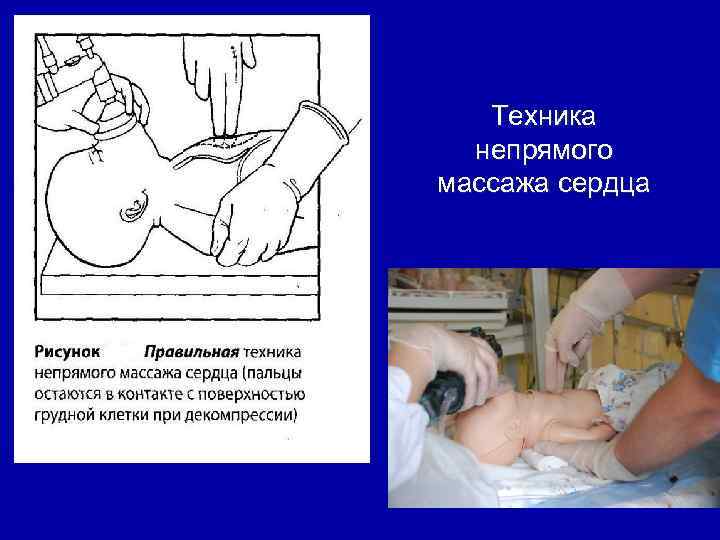 Техника непрямого массажа сердца 