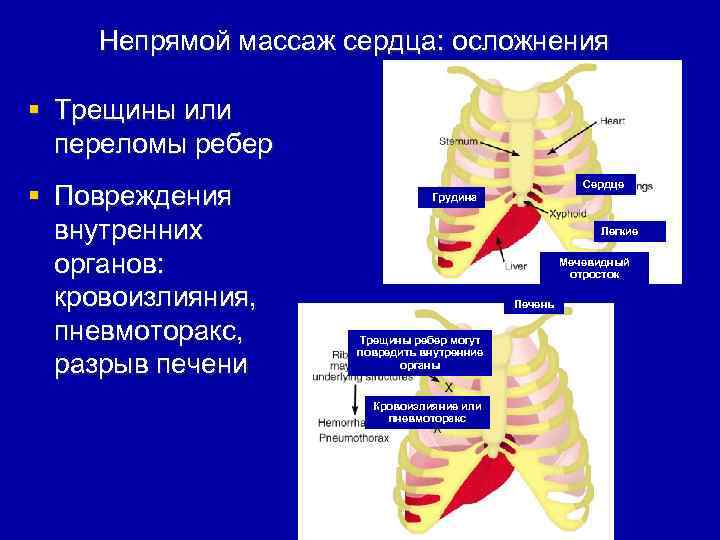 Непрямой массаж сердца: осложнения § Трещины или переломы ребер § Повреждения внутренних органов: кровоизлияния,