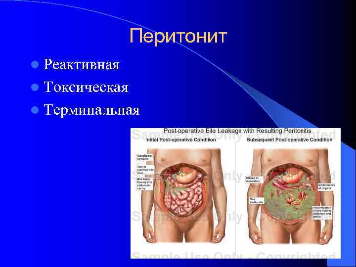 Перитонит l Реактивная l Токсическая l Терминальная 