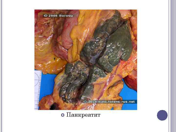  Панкреатит 