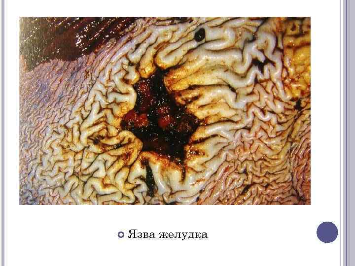  Язва желудка 