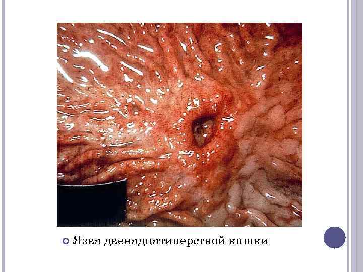  Язва двенадцатиперстной кишки 