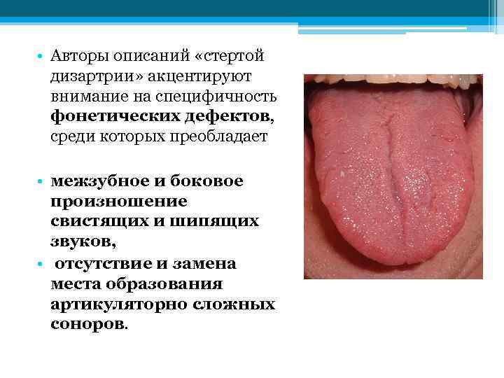 • Авторы описаний «стертой дизартрии» акцентируют внимание на специфичность фонетических дефектов, среди которых