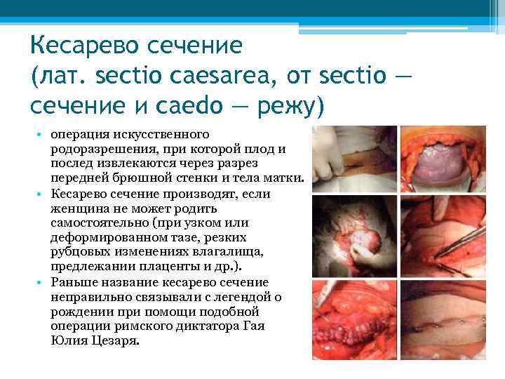 Кесарево сечение (лат. sectio caesarea, от sectio — сечение и caedo — режу) •