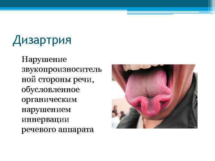 Дизартрия Нарушение звукопроизноситель ной стороны речи, обусловленное органическим нарушением иннервации речевого аппарата 