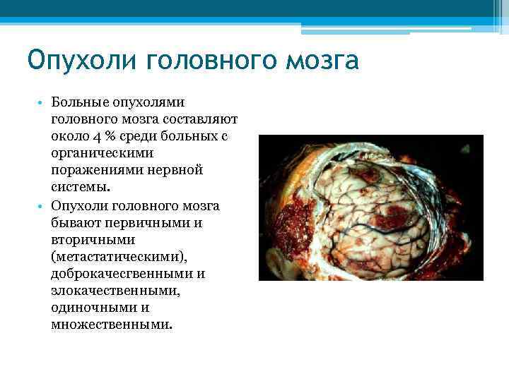 Опухоли головного мозга • Больные опухолями головного мозга составляют около 4 % среди больных