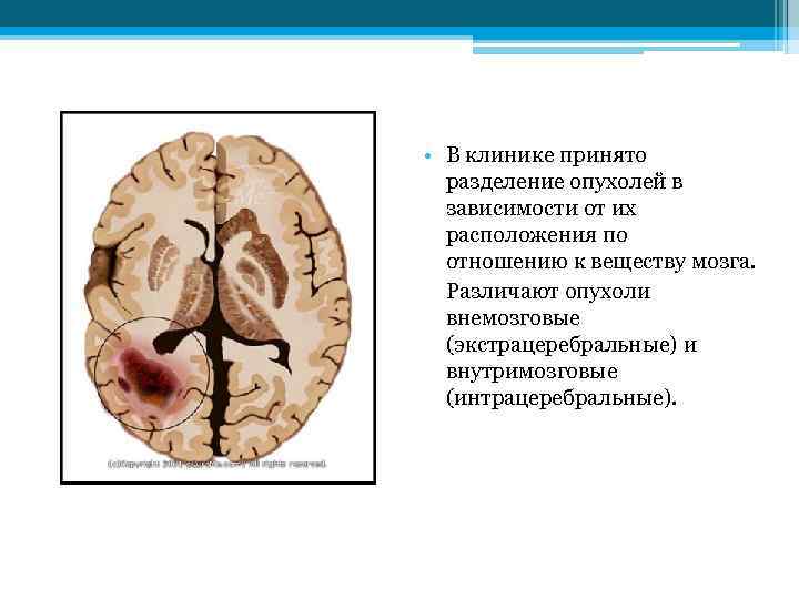  • В клинике принято разделение опухолей в зависимости от их расположения по отношению
