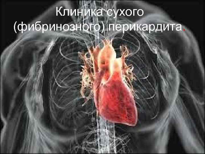 Клиника сухого (фибринозного) перикардита. 
