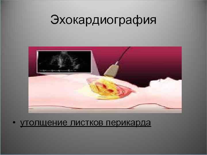 Эхокардиография • утолщение листков перикарда 