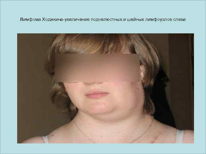 Лимфома Ходжкина-увеличение подчелюстных и шейных лимфоузлов слева 