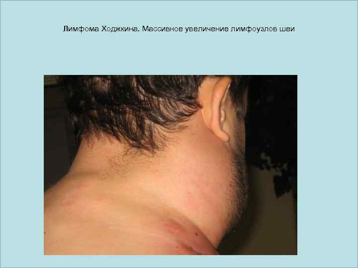 Лимфома Ходжкина. Массивное увеличение лимфоузлов шеи 
