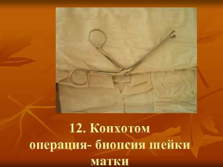 12. Конхотом операция- биопсия шейки матки 