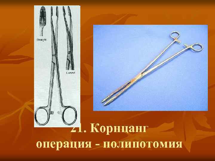 21. Корнцанг операция - полипотомия 