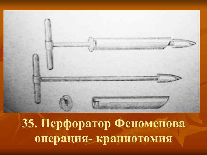35. Перфоратор Феноменова операция- краниотомия 