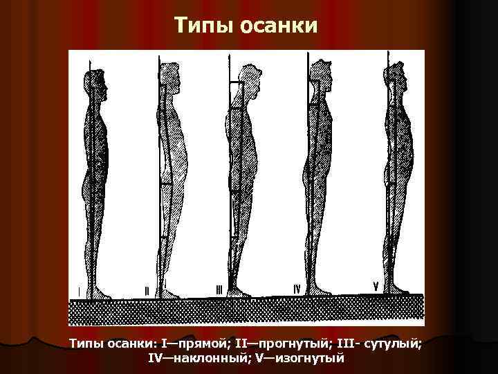 Типы осанки: I—прямой; II—прогнутый; III- сутулый; IV—наклонный; V—изогнутый 