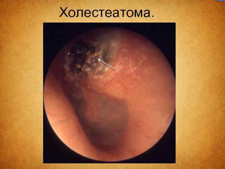Холестеатома. 