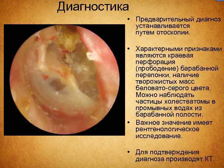 Диагностика • Предварительный диагноз устанавливается путем отоскопии. • Характерными признаками являются краевая перфорация (прободение)