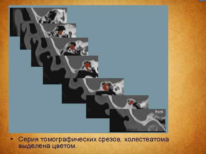 • Серия томографических срезов, холестеатома выделена цветом. 