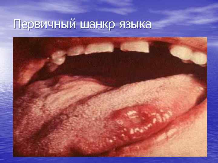 Первичный шанкр языка 