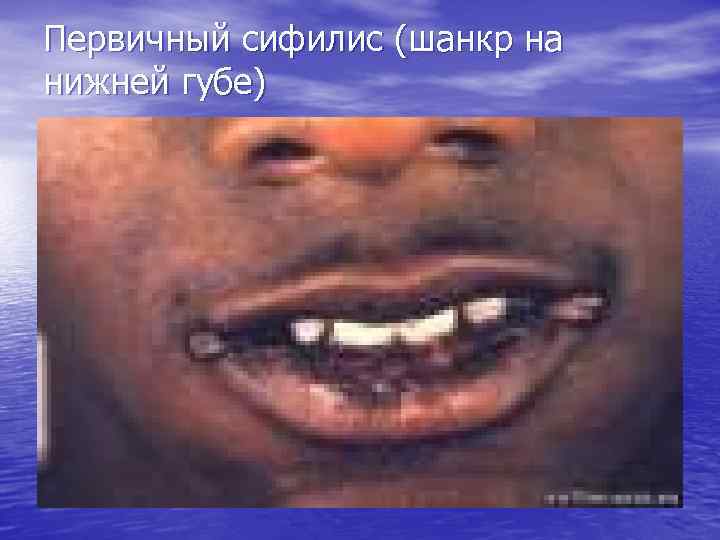Первичный сифилис (шанкр на нижней губе) 