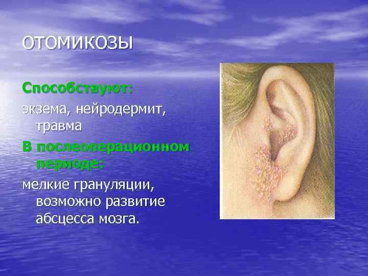 отомикозы Способствуют: экзема, нейродермит, травма В послеоперационном периоде: мелкие грануляции, возможно развитие абсцесса мозга.