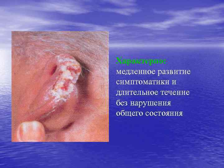 Характерно: медленное развитие симптоматики и длительное течение без нарушения общего состояния 
