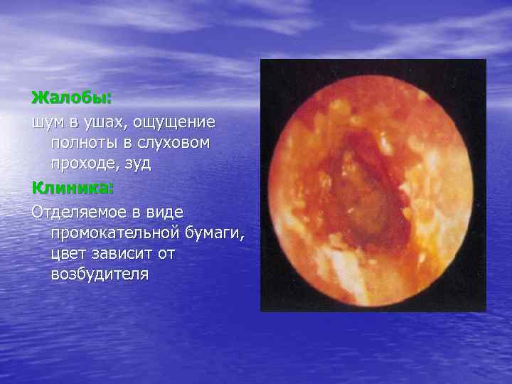 Жалобы: шум в ушах, ощущение полноты в слуховом проходе, зуд Клиника: Отделяемое в виде