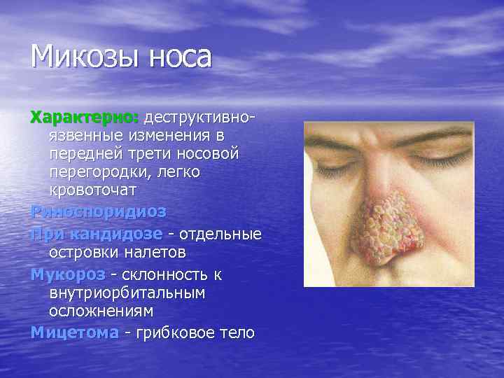 Микозы носа Характерно: деструктивноязвенные изменения в передней трети носовой перегородки, легко кровоточат Риноспоридиоз При