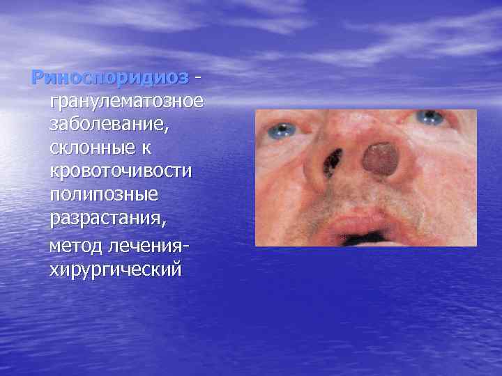 Риноспоридиоз гранулематозное заболевание, склонные к кровоточивости полипозные разрастания, метод леченияхирургический 