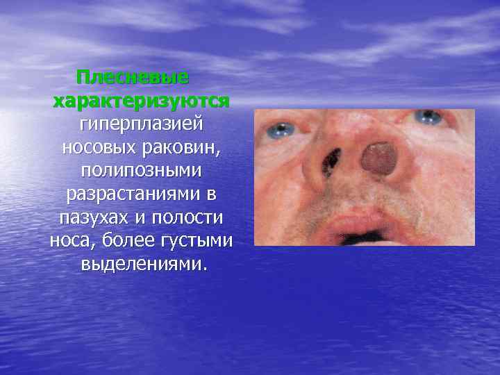 Плесневые характеризуются гиперплазией носовых раковин, полипозными разрастаниями в пазухах и полости носа, более густыми