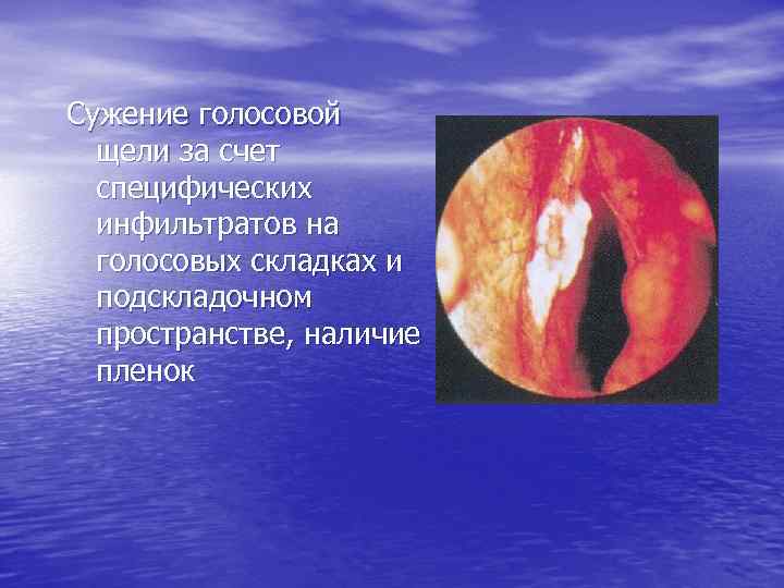 Сужение голосовой щели за счет специфических инфильтратов на голосовых складках и подскладочном пространстве, наличие